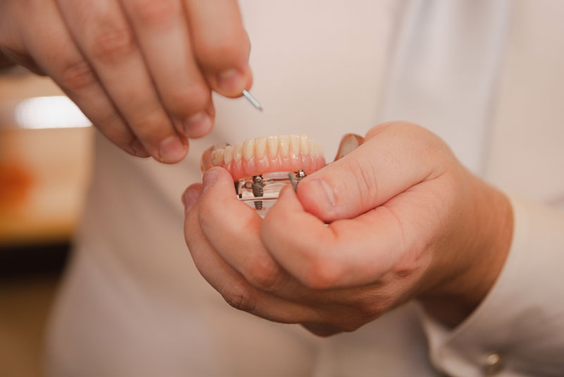 full arch implant model being held surgeon